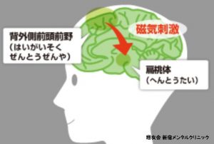 帝人ファーマの独占的販売権を取得でTMS治療が拡大する