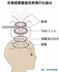 薬事承認された反復頭蓋磁気刺激療法はうつ病患者に朗報