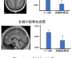 MRIで正確に双極性障害とうつ病を区別して診断する方法